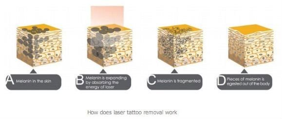 Klinik profesional saklar q nd yag sistem laser penghapusan tato dengan promosi besar